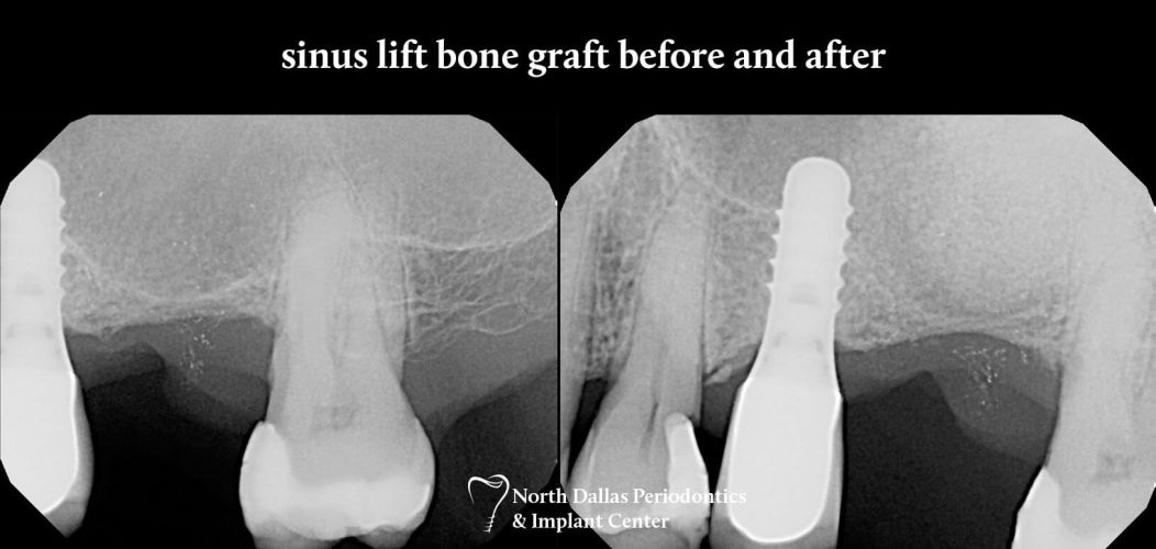 Marjan Adami DDS, Periodontist patient photos sinus lift bone graft before and after