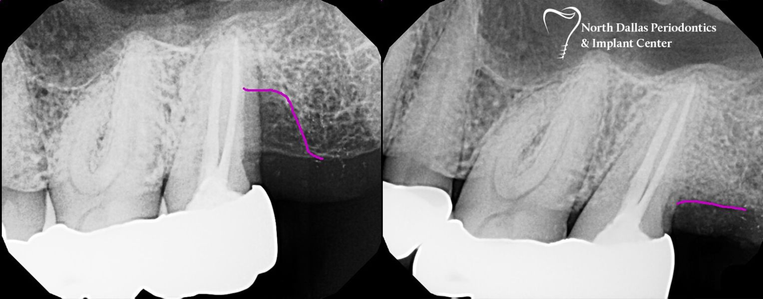 Marjan Adami DDS, Periodontist patient photos before and after